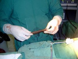 Cura de hernia incisional laparoscopico