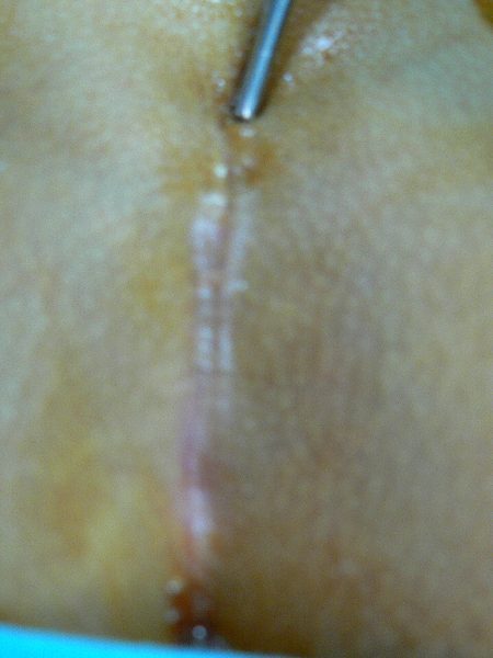 Resección quiste pilonidal