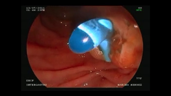 Colocación de Stent para drenaje biliar en Neoplasia – Cabeza del páncreas